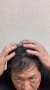 頭皮が気になる男性｜薄毛｜悩み