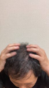 頭皮を揉み込む男性｜薄毛