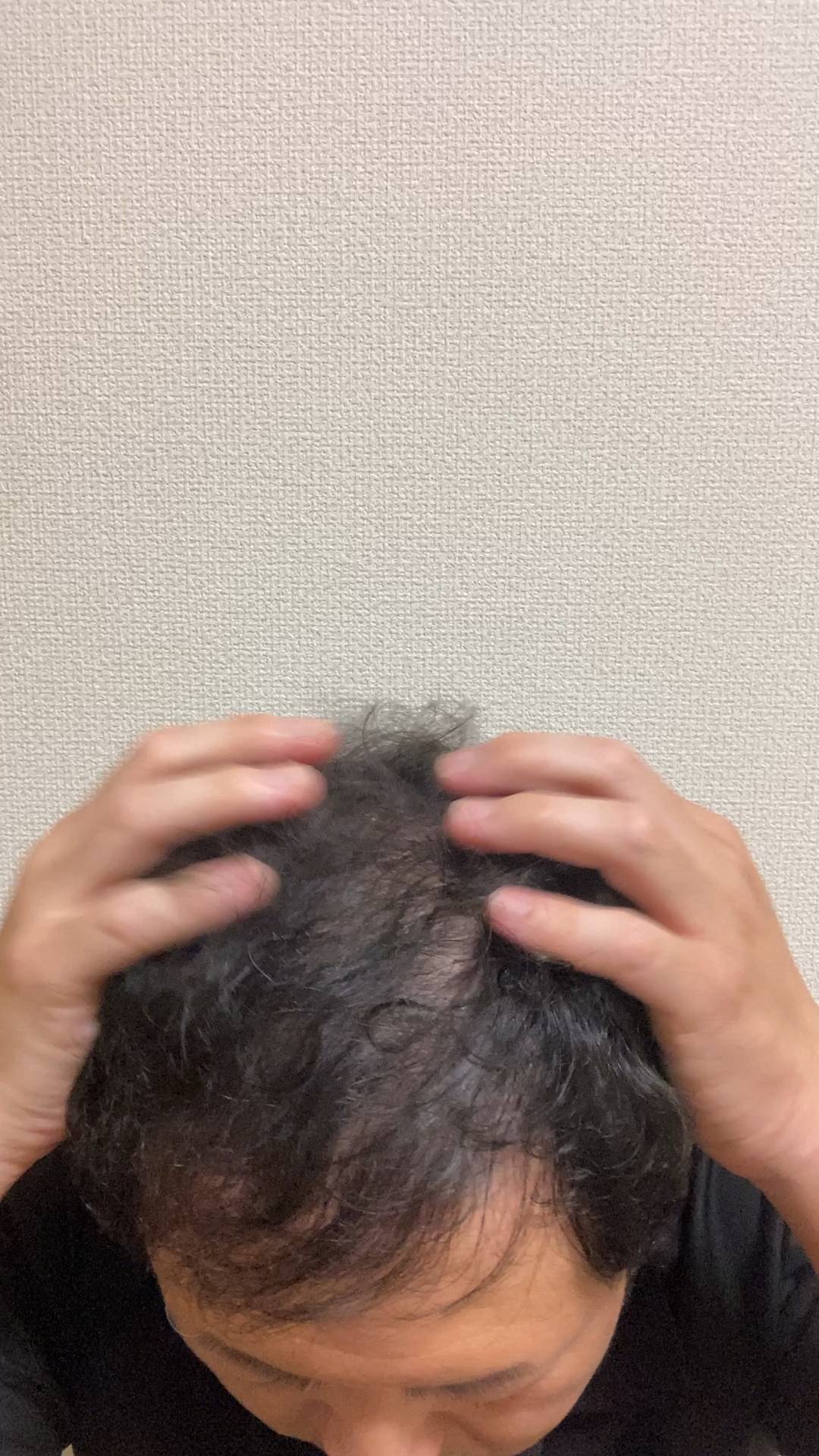 頭皮を揉み込む男性｜薄毛