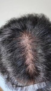 薄毛の男性｜AGA