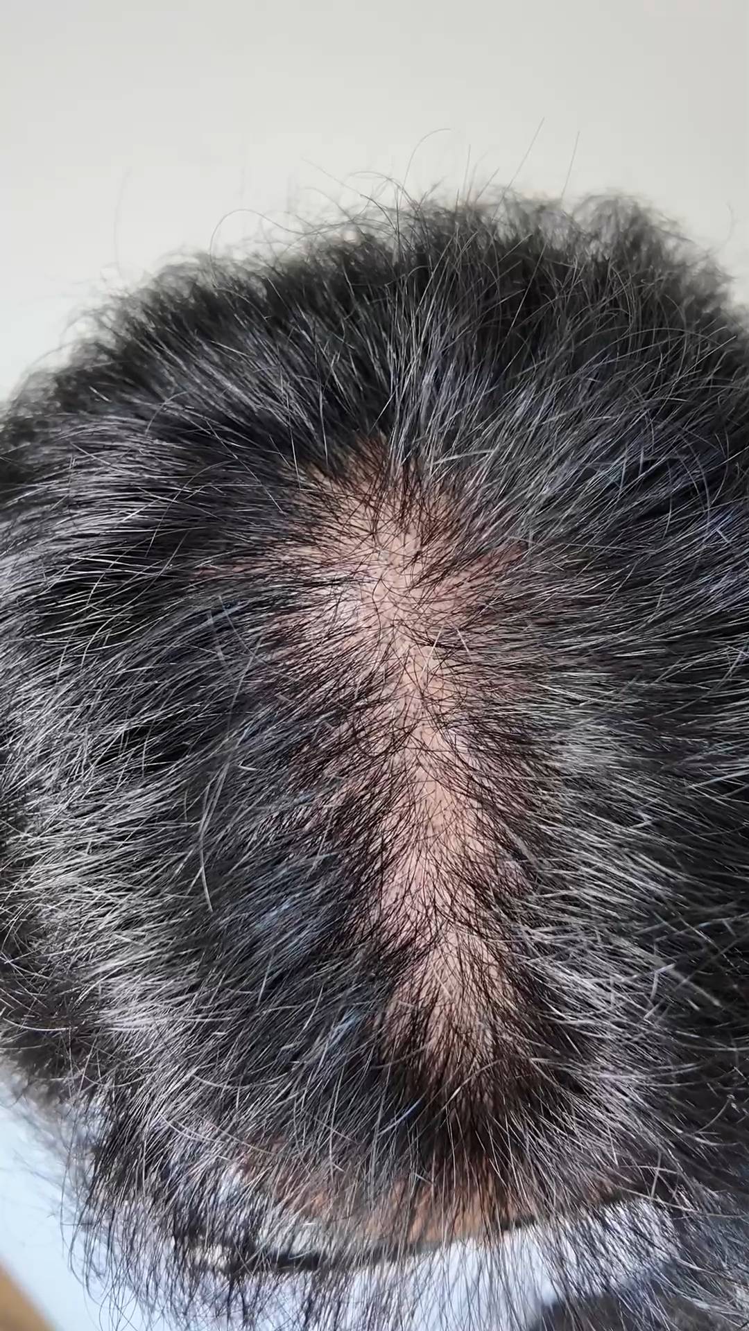 薄毛の男性｜AGA