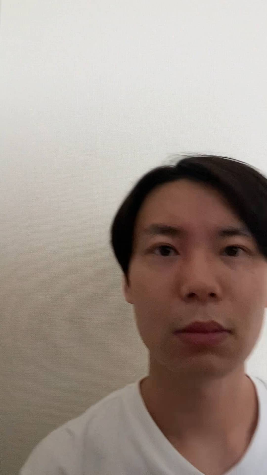 生え際が気になる20代｜薄毛｜育毛｜植毛